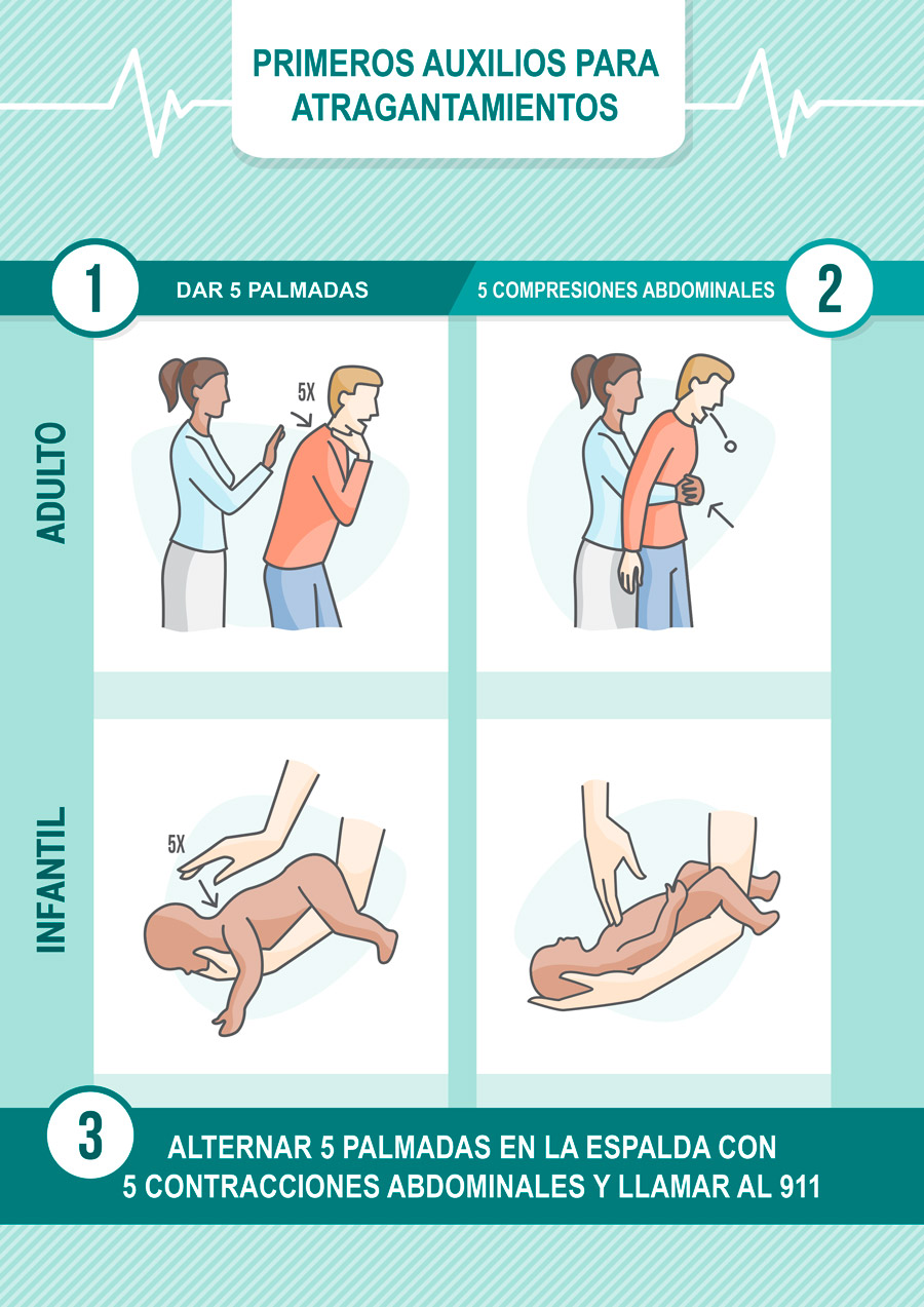 maniobra heimlich y c&oacute;mo realizarla