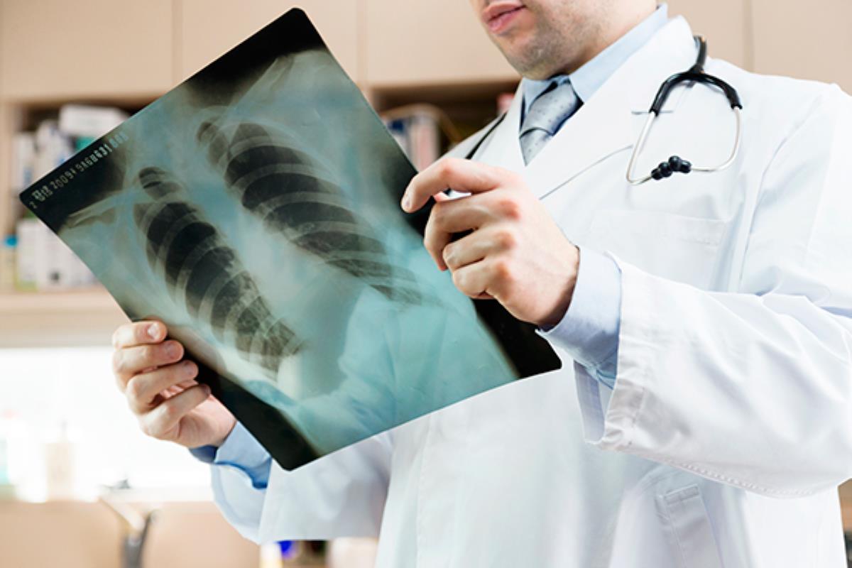 La prueba de pulmón EarlyCDT ya ha resultado exitosa en su primera prueba con una muestra de 12.209 personas