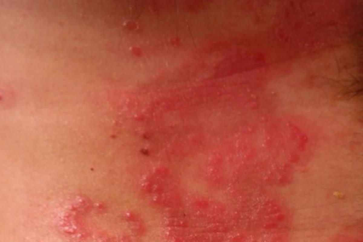 Los hallazgos de investigadores de la Universidad de Zúrich apuntan a que el sistema inmunológico que nos protege de los hongos podrían estimular los síntomas de la dermatitis