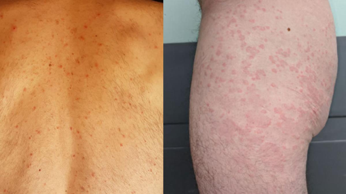 Se produce por la reactivación del virus de la varicela