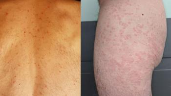 Se produce por la reactivación del virus de la varicela