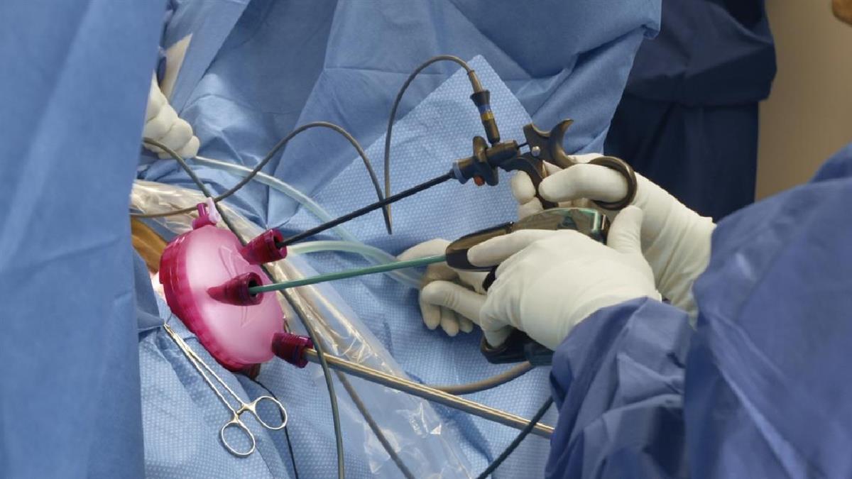 La técnica 'V-Notes' aporta una recuperación más rápida y acorta postoperatorio