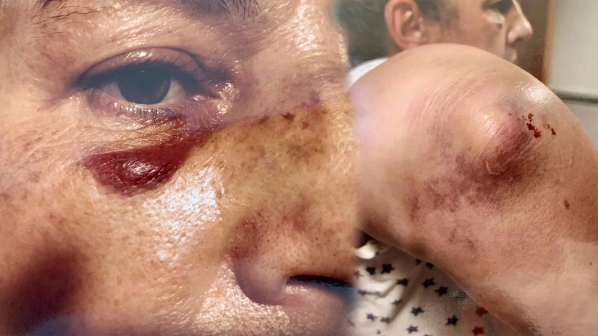 Con una nariz y un codo roto