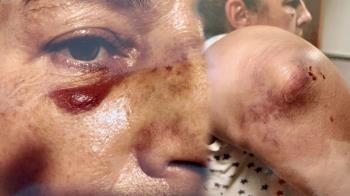 Con una nariz y un codo roto