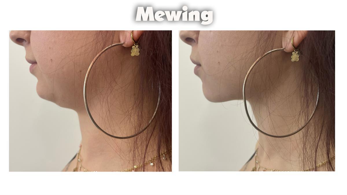 Mewing: Qué es y por qué personas lo ocupan para su rostro