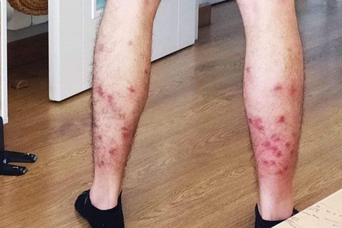 Estaba jugando al pádel cuando fue acribillado por los mosquitos y tuvo que acudir a urgencias